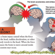 What You Need to Know About Head Injury