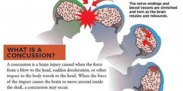 A Sport Where You Purposely Incur Head Injuries?