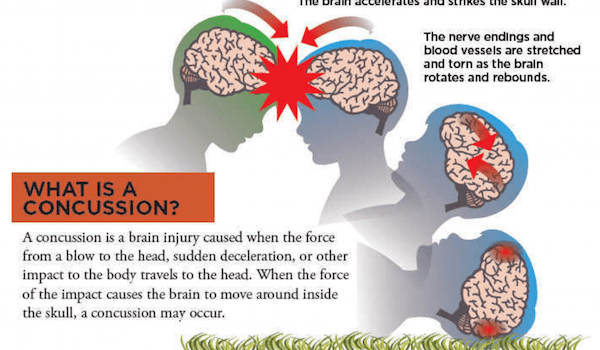 What You Need to Know About Head Injury